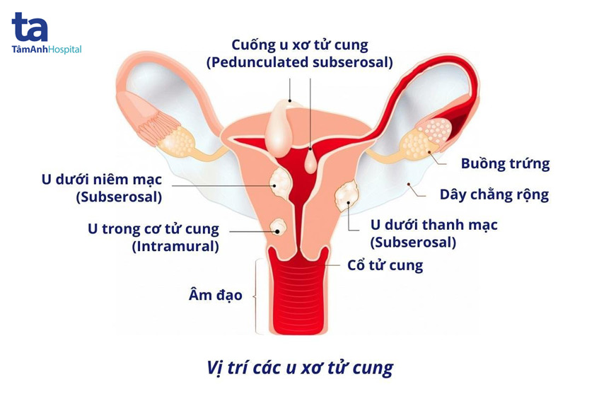 U xơ tử cung: Nguyên nhân, triệu chứng, chẩn đoán và phòng ngừa