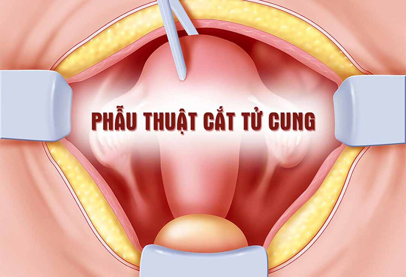 Cách kiểm tra sa tử cung, hướng xử trí và các biện pháp phòng ngừa sa tử cung